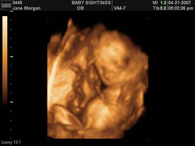 3d ultrasound pictures at 26 weeks. 3d ultrasound pictures at 26